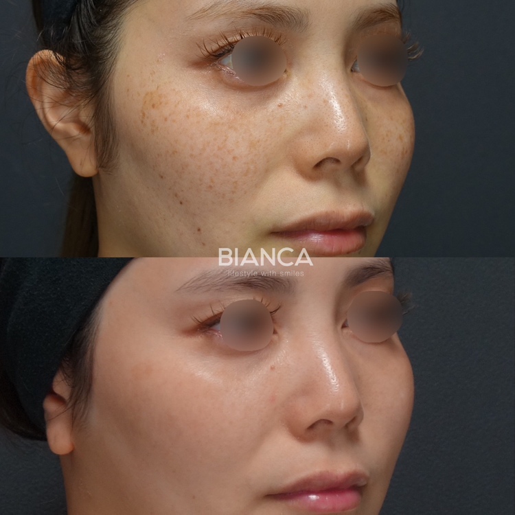 ピコスポット1回 ピコトーニング20回