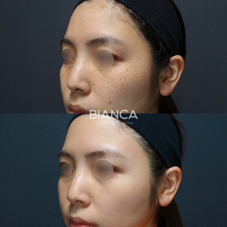 ピコスポット1回 ピコトーニング20回