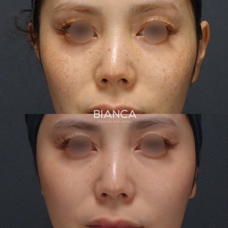 ピコスポット1回 ピコトーニング20回