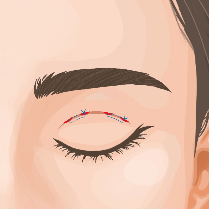 二重埋没法 2点留め・4点留め