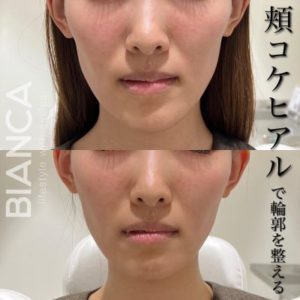 頬コケヒアル症例