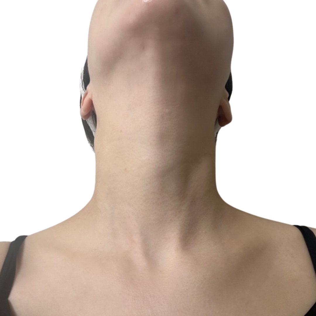 CO2レーザー（ホクロ・イボ取り）