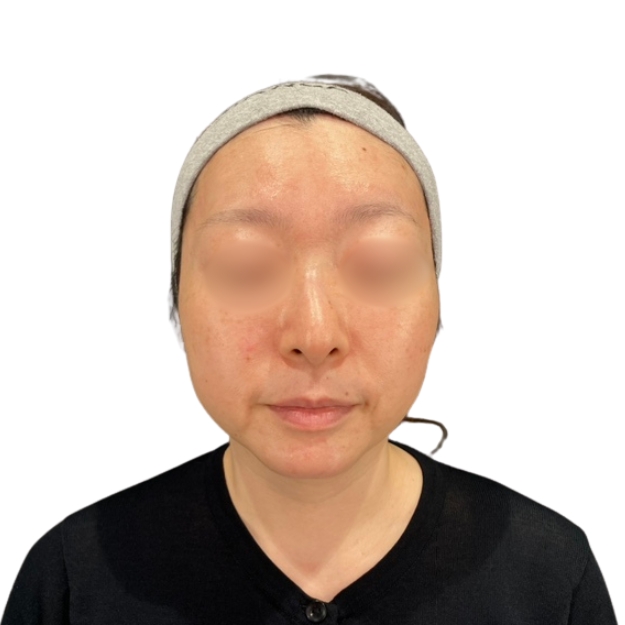 マッサージピール