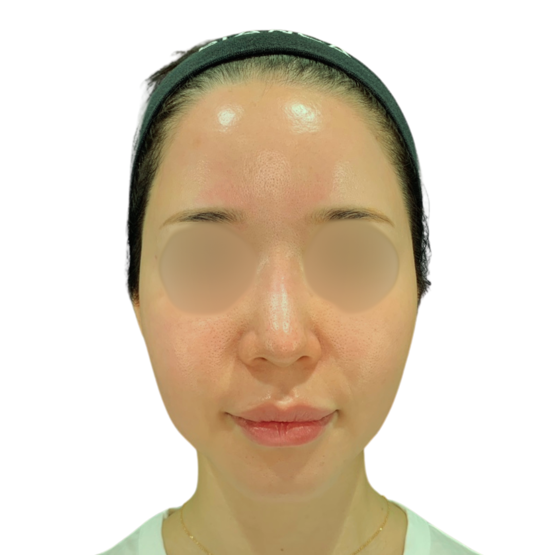 ハイドラフェイシャル