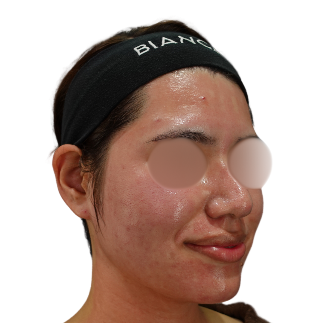 ヴェルヴェットスキン（ダーマペン4）