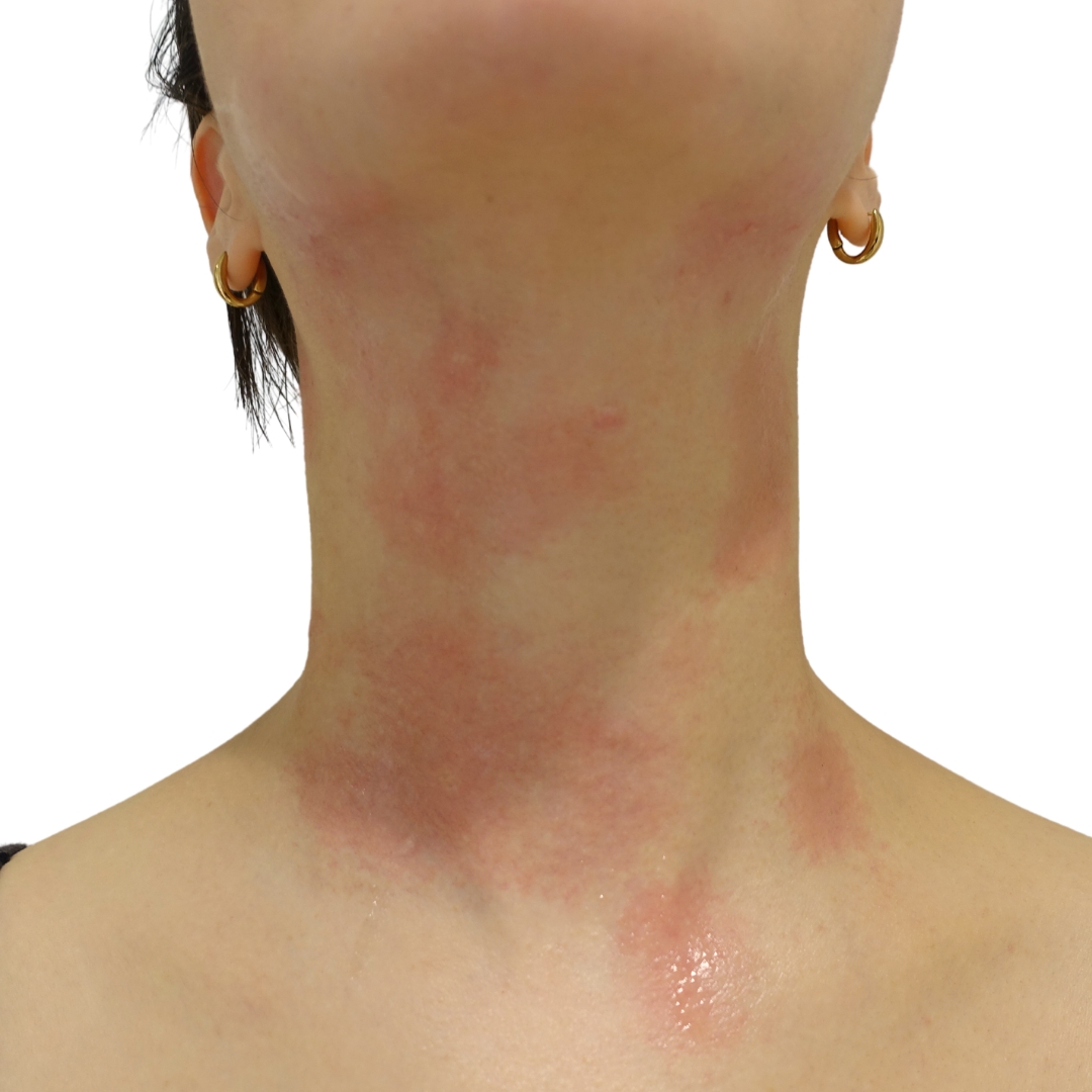 CO2レーザー（ホクロ・イボ取り）