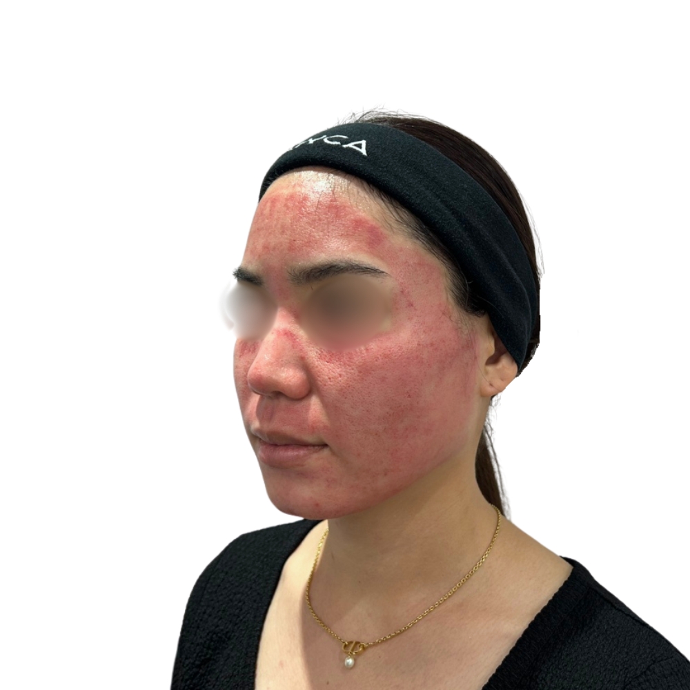 ヴァンパイアフェイシャル