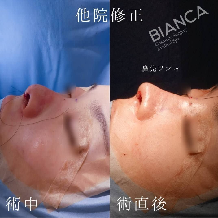 鼻骨骨切り・鼻中隔延長・鼻尖形成