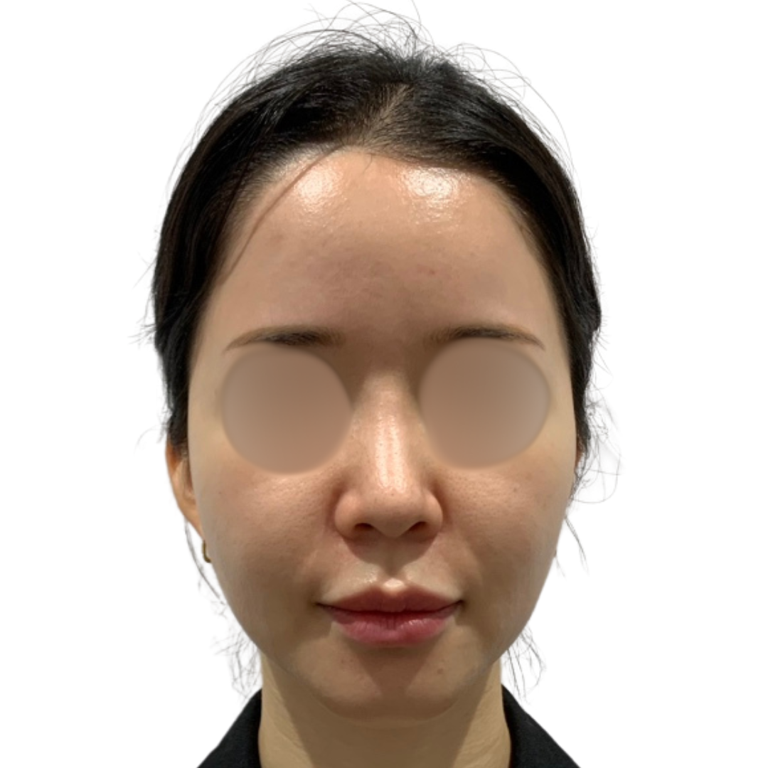 ハイドラフェイシャル