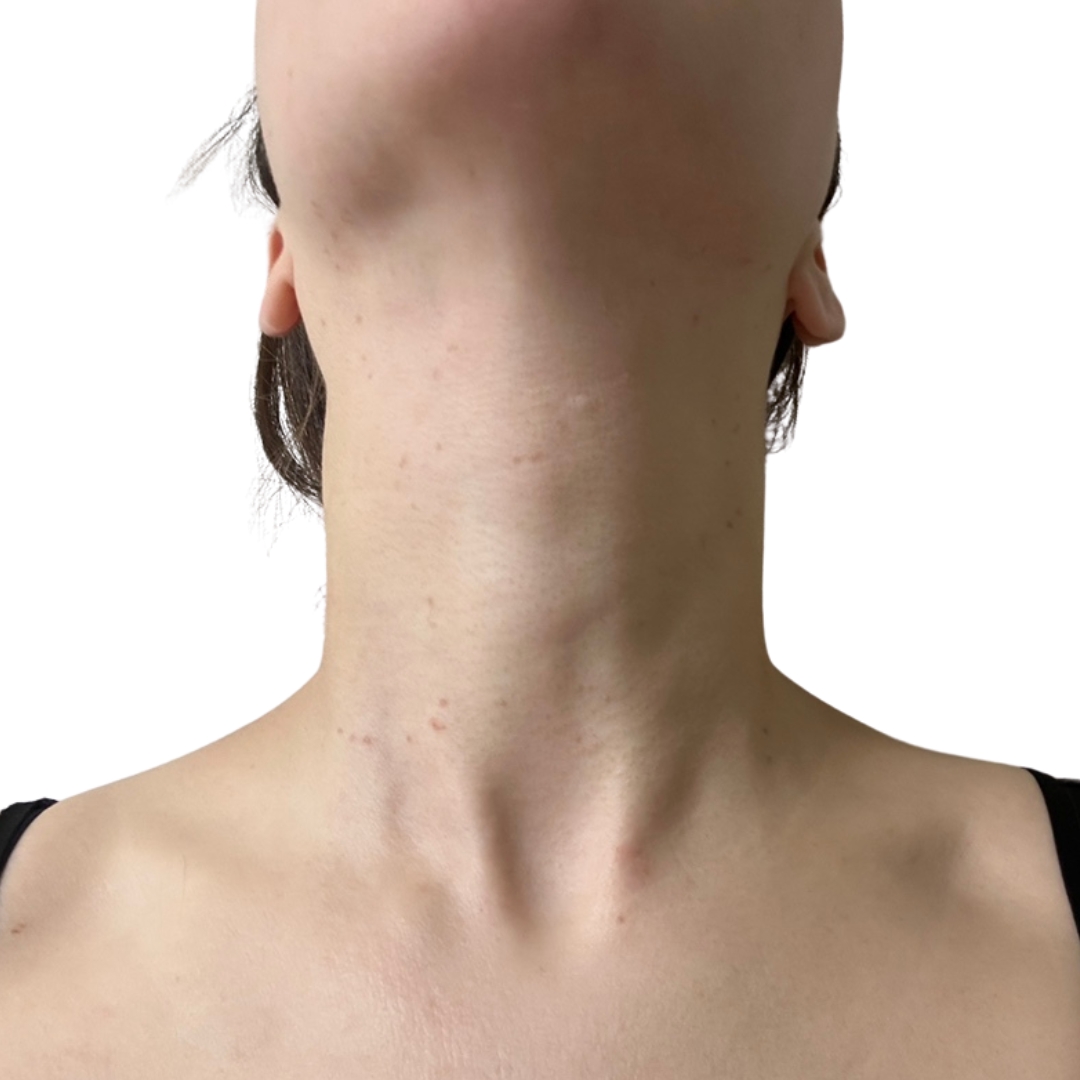 CO2レーザー（ホクロ・イボ取り）