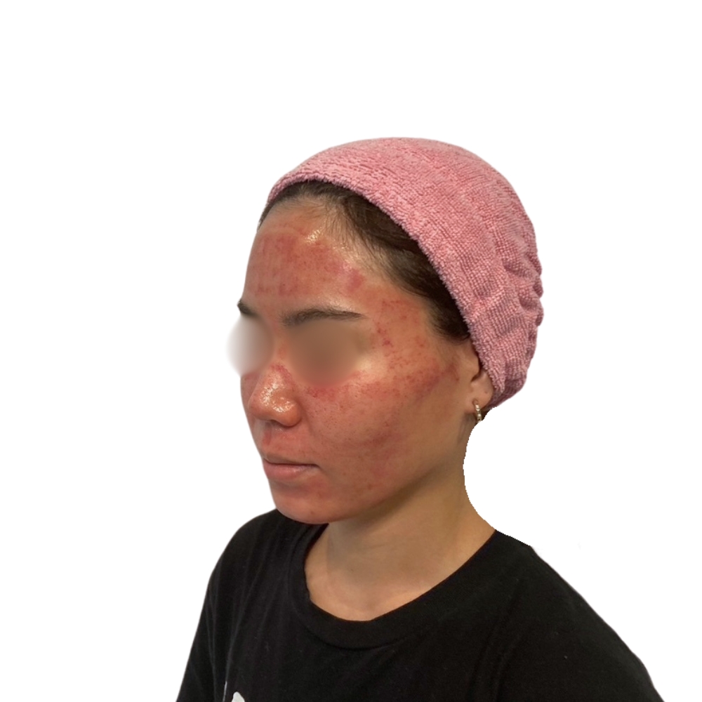 ヴァンパイアフェイシャル