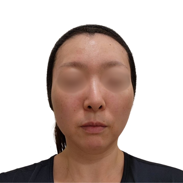 マッサージピール