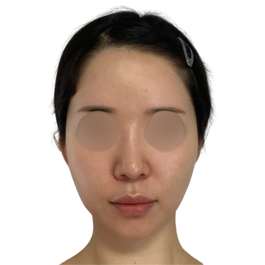 ハイドラフェイシャル