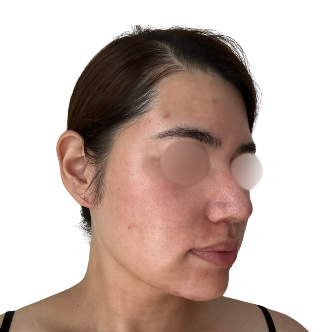 ヴェルヴェットスキン（ダーマペン4）