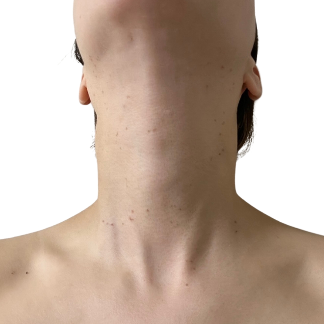 CO2レーザー（ホクロ・イボ取り）