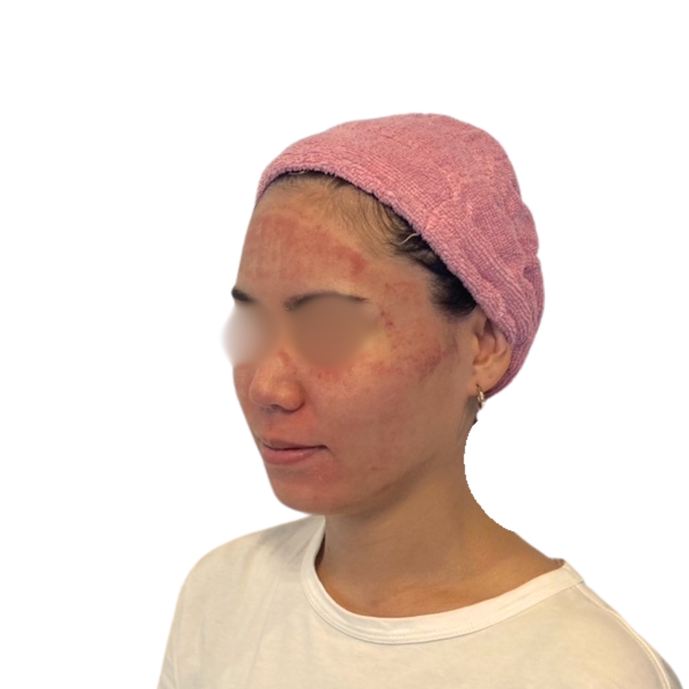 ヴァンパイアフェイシャル