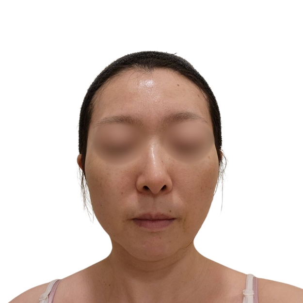 マッサージピール