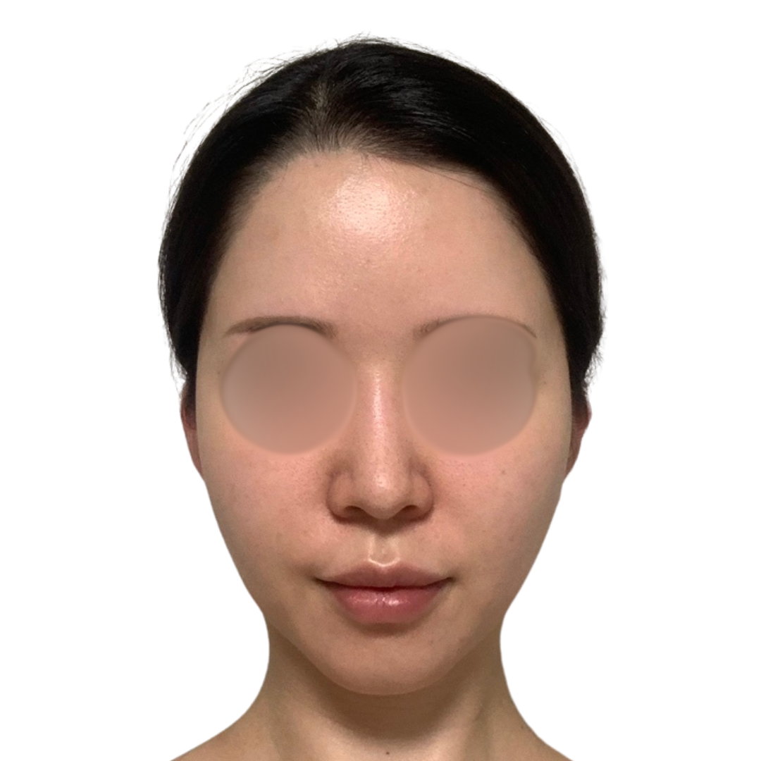 ハイドラフェイシャル