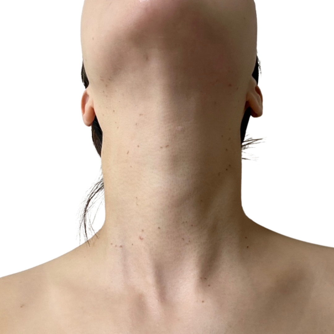 CO2レーザー（ホクロ・イボ取り）