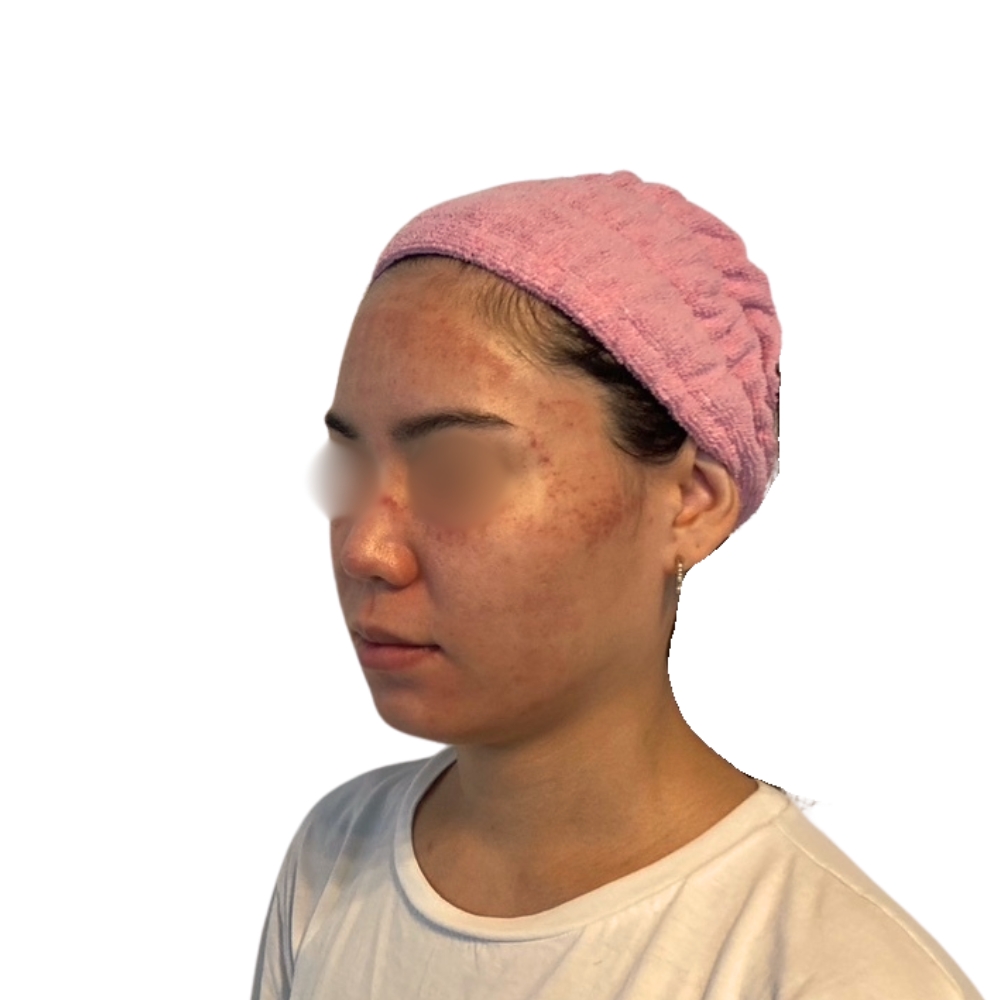 ヴァンパイアフェイシャル