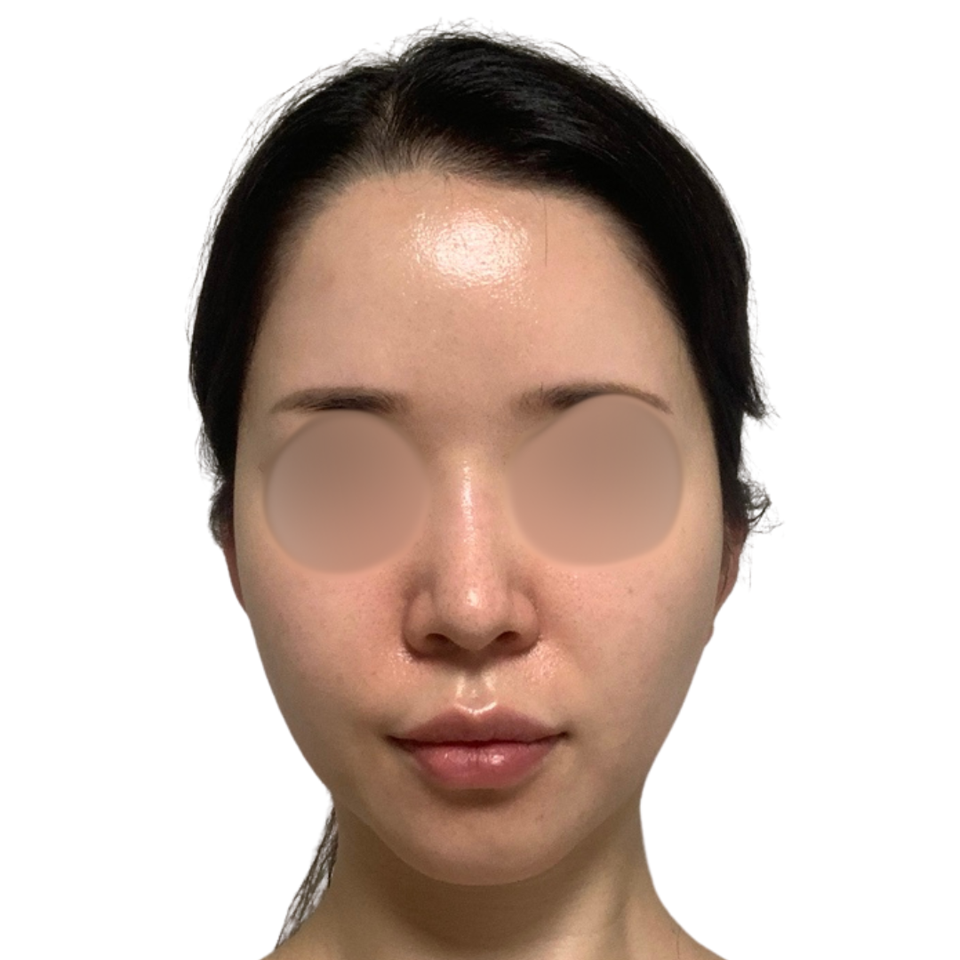 ハイドラフェイシャル