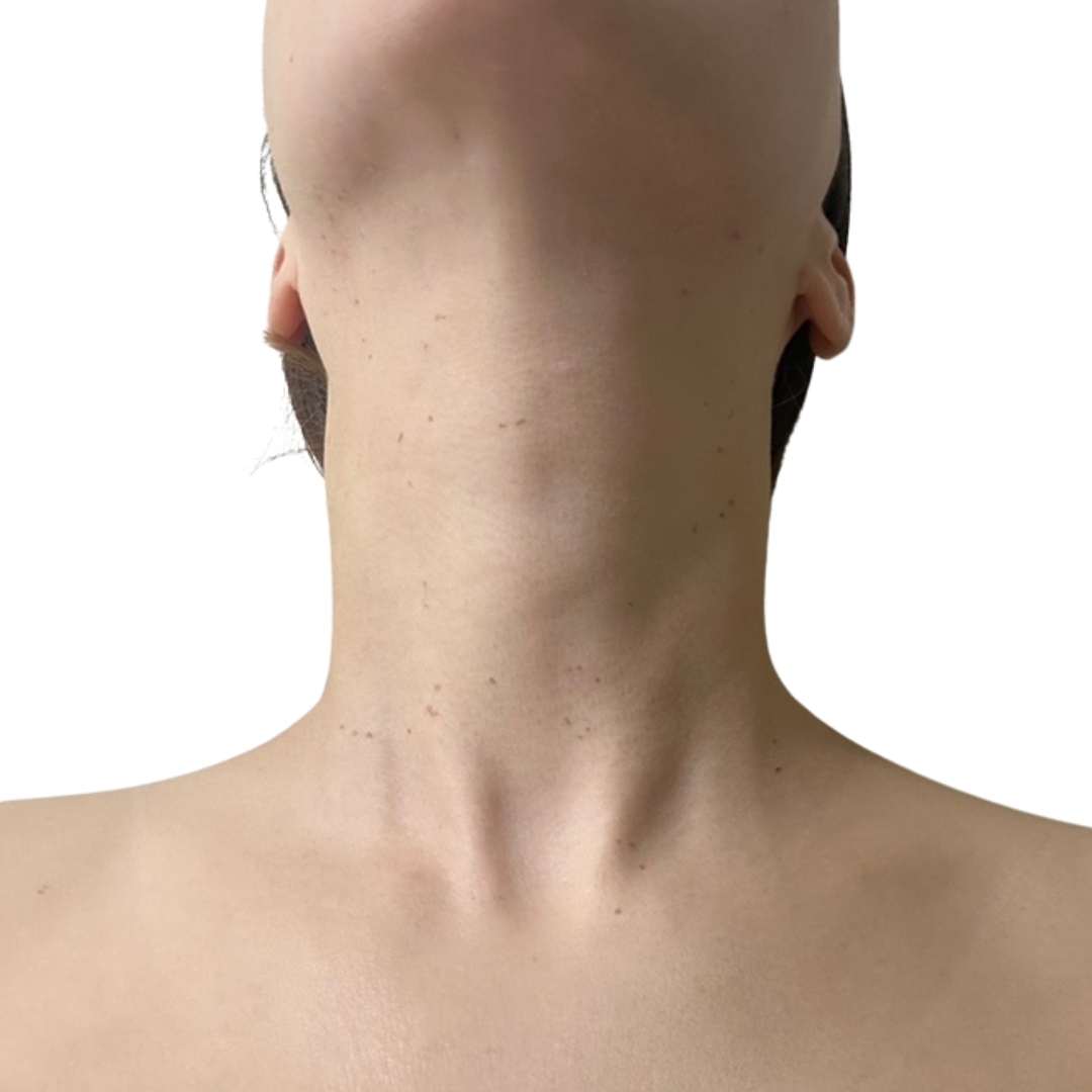 CO2レーザー（ホクロ・イボ取り）