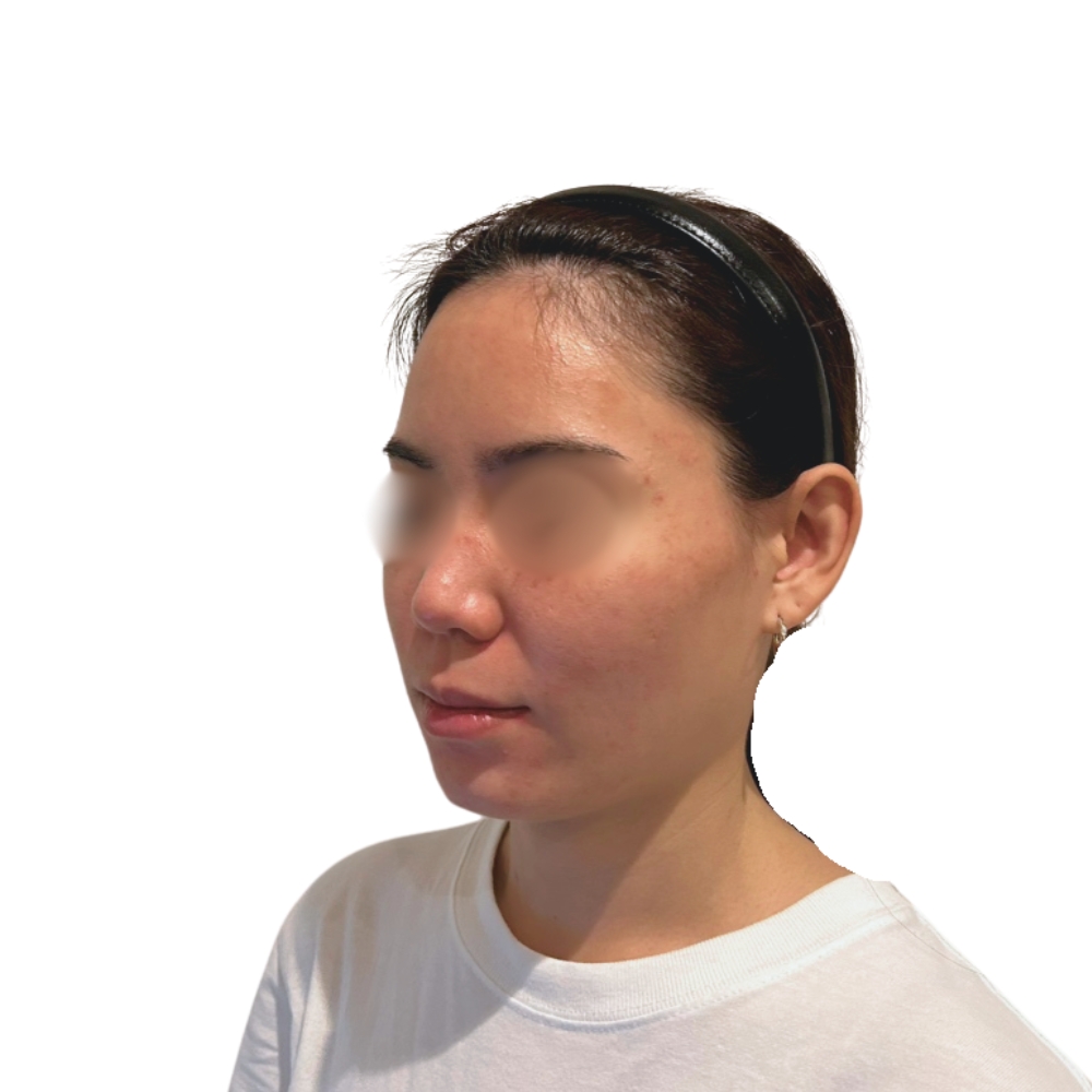 ヴァンパイアフェイシャル