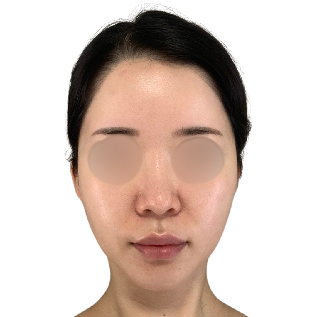 ハイドラフェイシャル