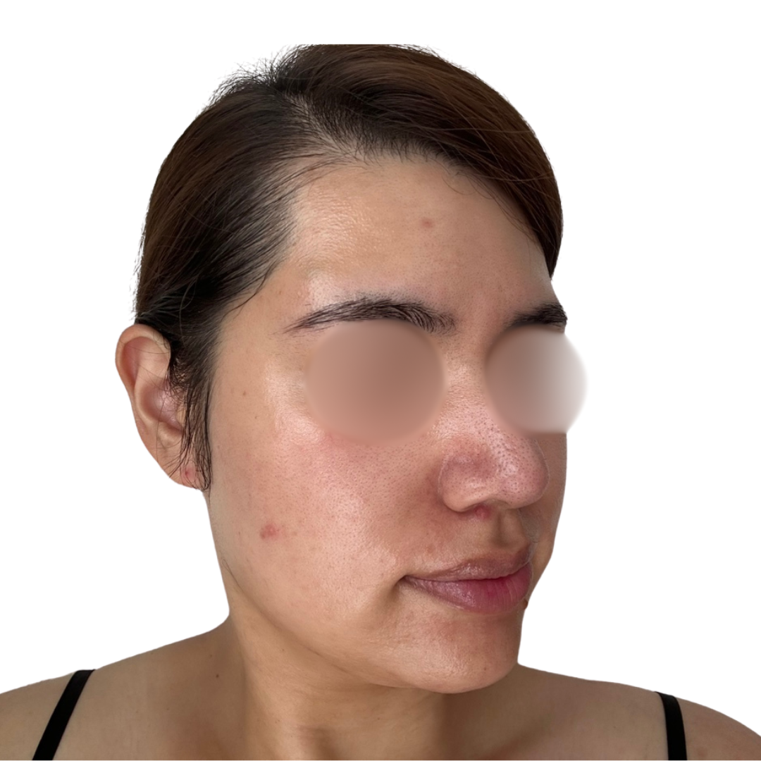 ヴェルヴェットスキン（ダーマペン4）