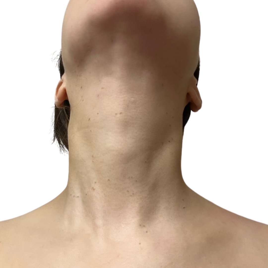 CO2レーザー（ホクロ・イボ取り）