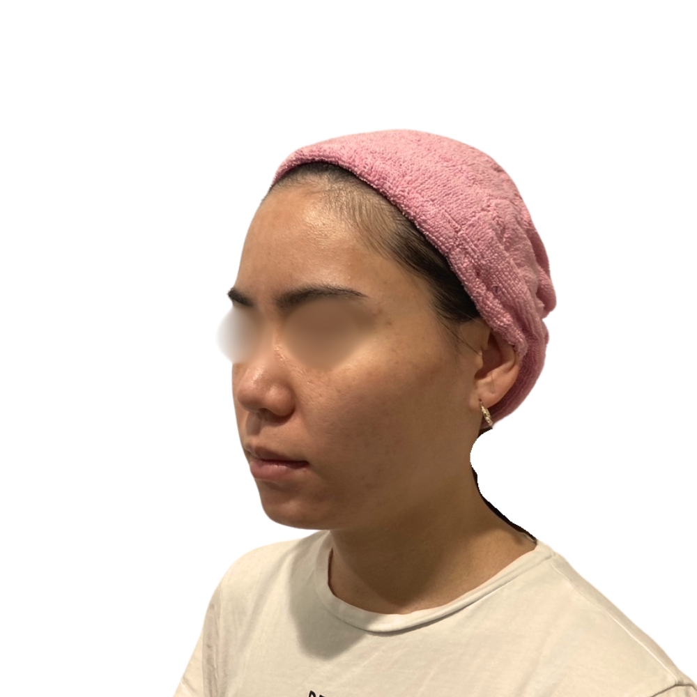 ヴァンパイアフェイシャル