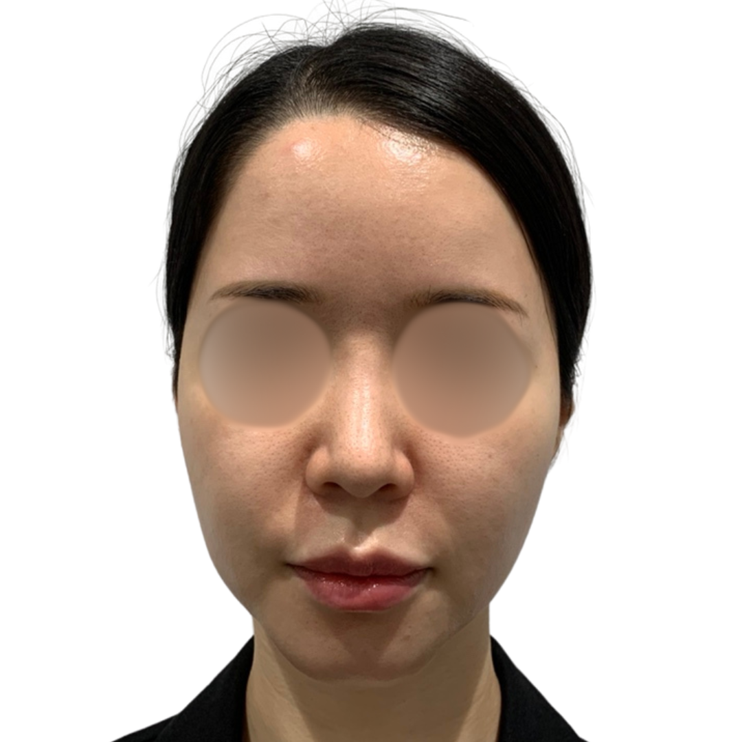 ハイドラフェイシャル