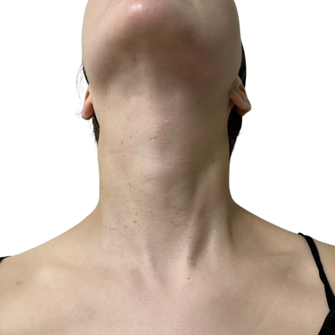 CO2レーザー（ホクロ・イボ取り）