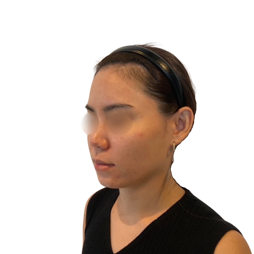 ヴァンパイアフェイシャル