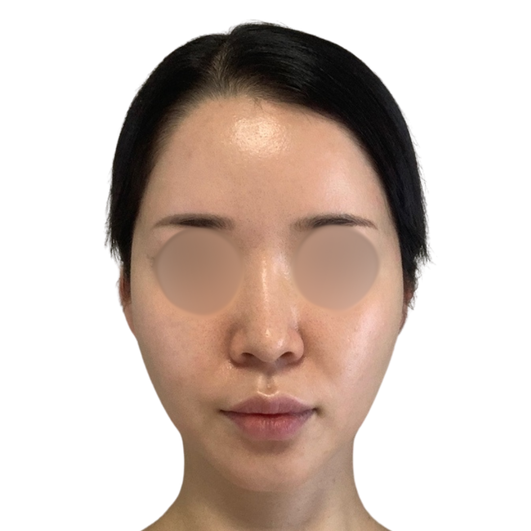 ハイドラフェイシャル