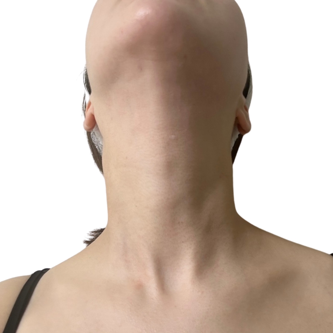 CO2レーザー（ホクロ・イボ取り）