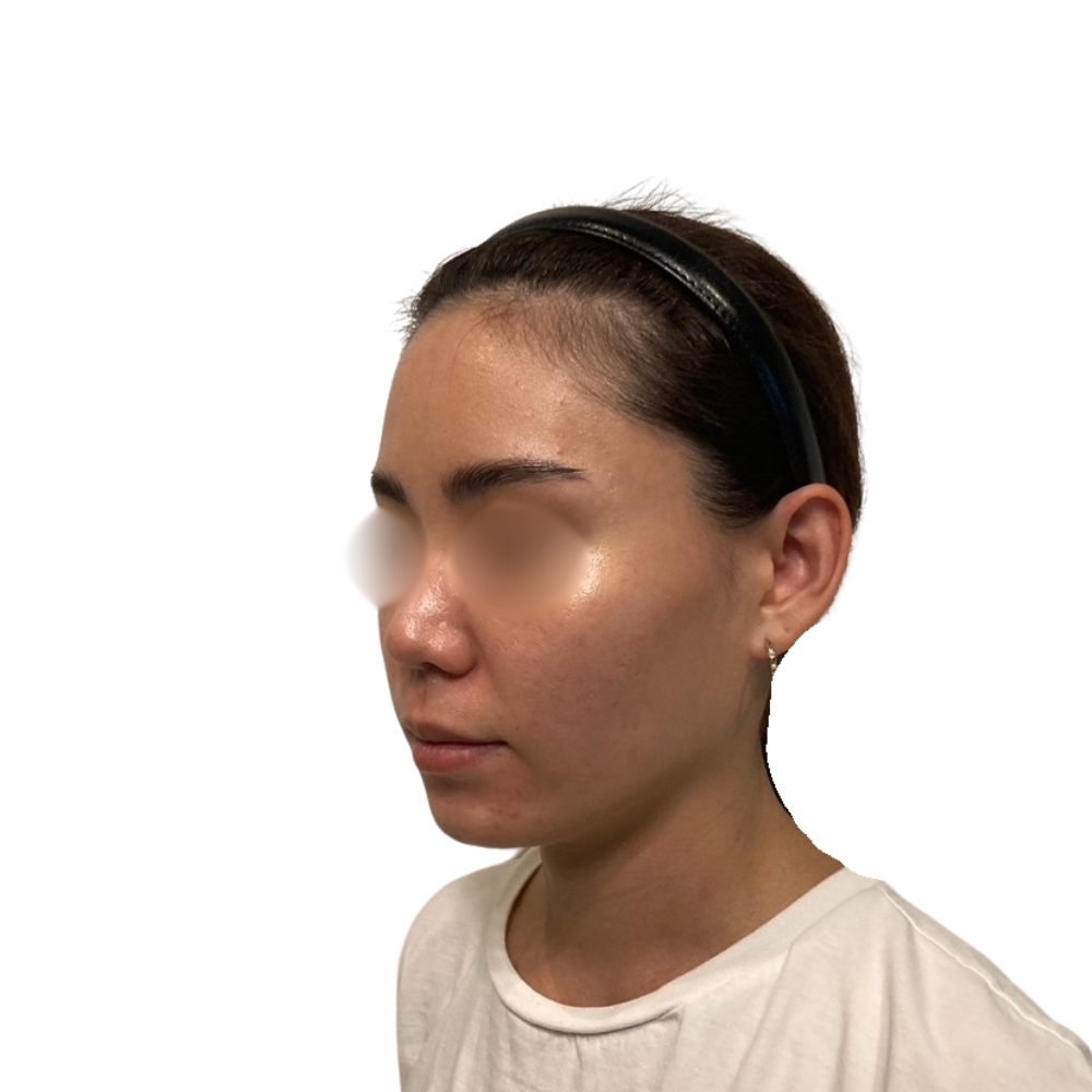 ヴァンパイアフェイシャル