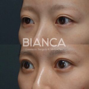 脱脂・二重全切開の症例写真