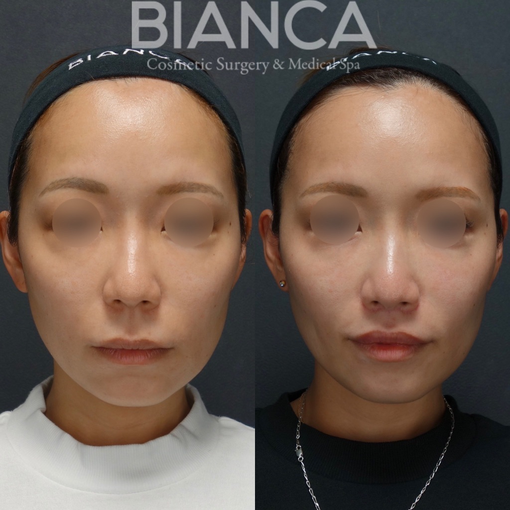 リップリフト（人中短縮） 