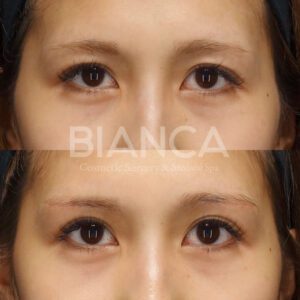 上:術前 下:術後1週間 抜糸直後<br />📍眉下切開<br />💴298,000円<br />😷DT:腫れ・内出血 10日程度<br />🤕抜糸:1週間後<br />⚠️リスク:感染・左右差・瘢痕など