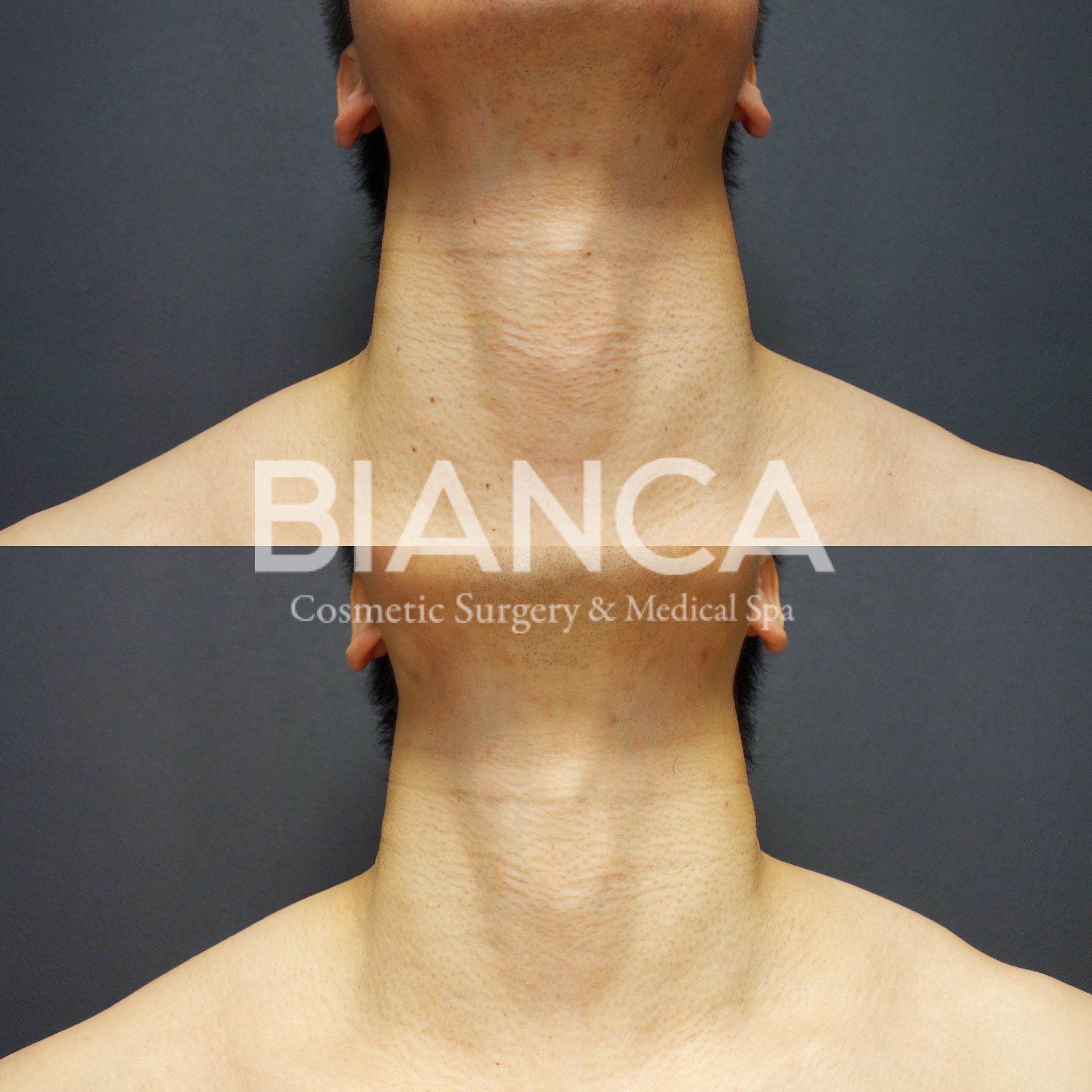 CO2レーザー（ホクロ・イボ取り）