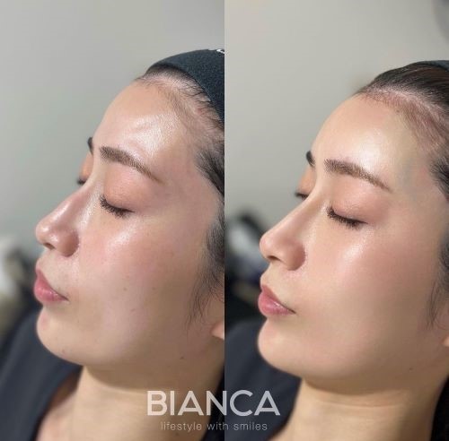 ヒアルロン酸注射