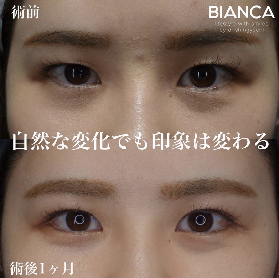 埋没法（マルチプルノット）・目尻切開・グラマラスライン形成