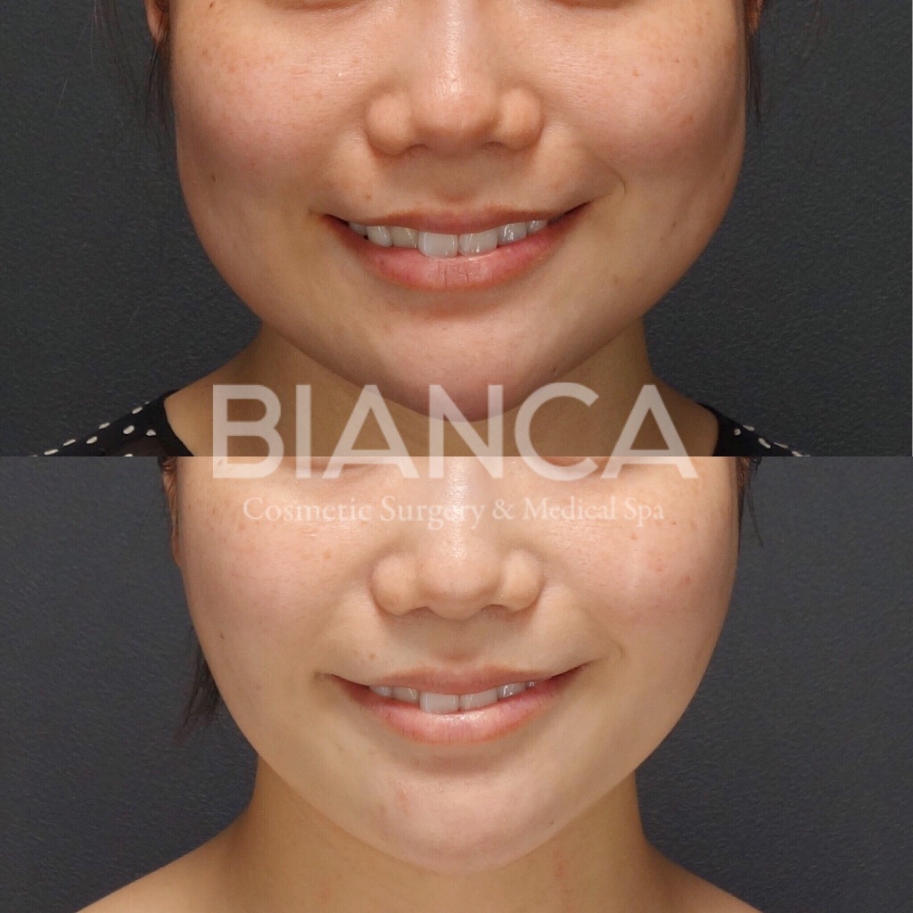 バッカルファット除去