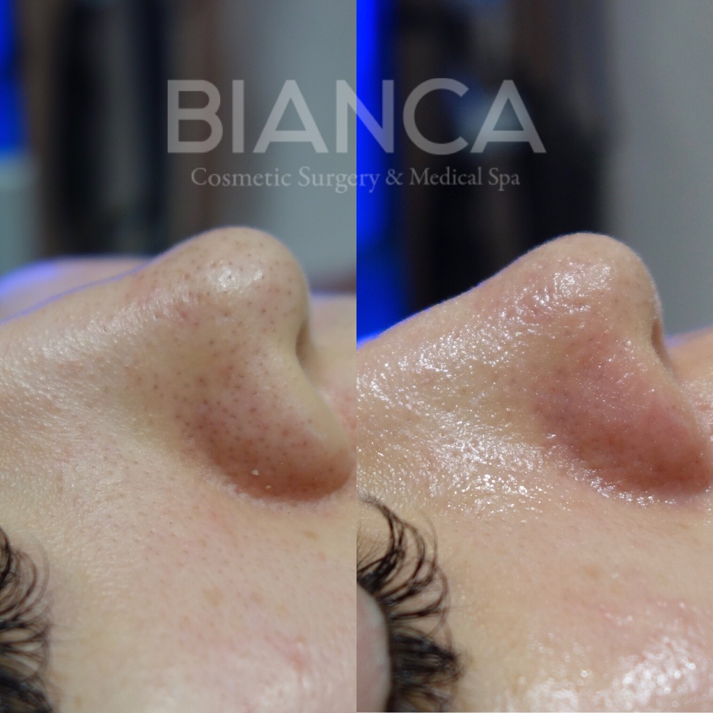 ハイドラフェイシャル（Hydrafacial）