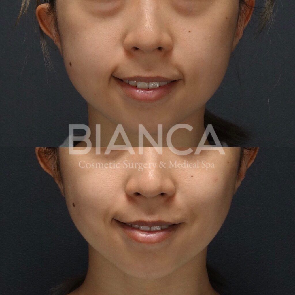 バッカルファット除去