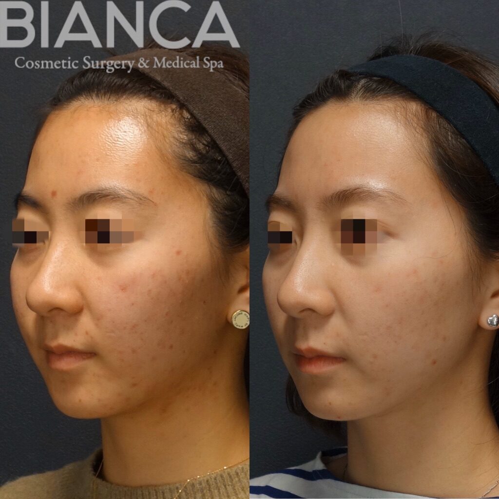 あき　　ハイドラフェイシャル ハイドラフェイシャル（Hydrafacial）・ロアキュテイン（ROACCUTANE）
