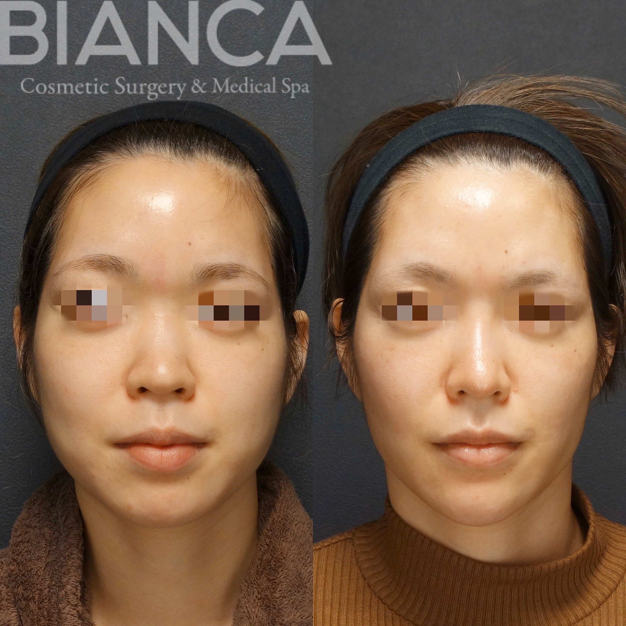 バッカルファット除去