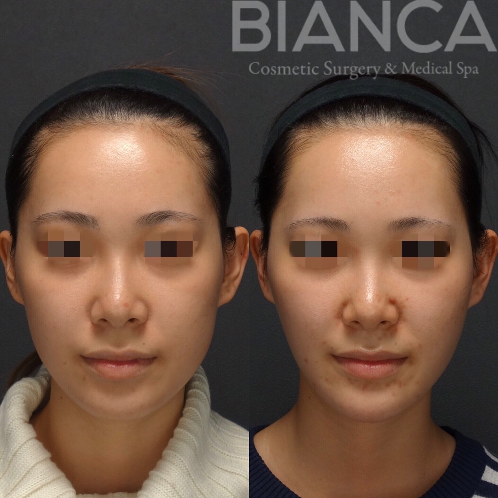 バッカルファット除去