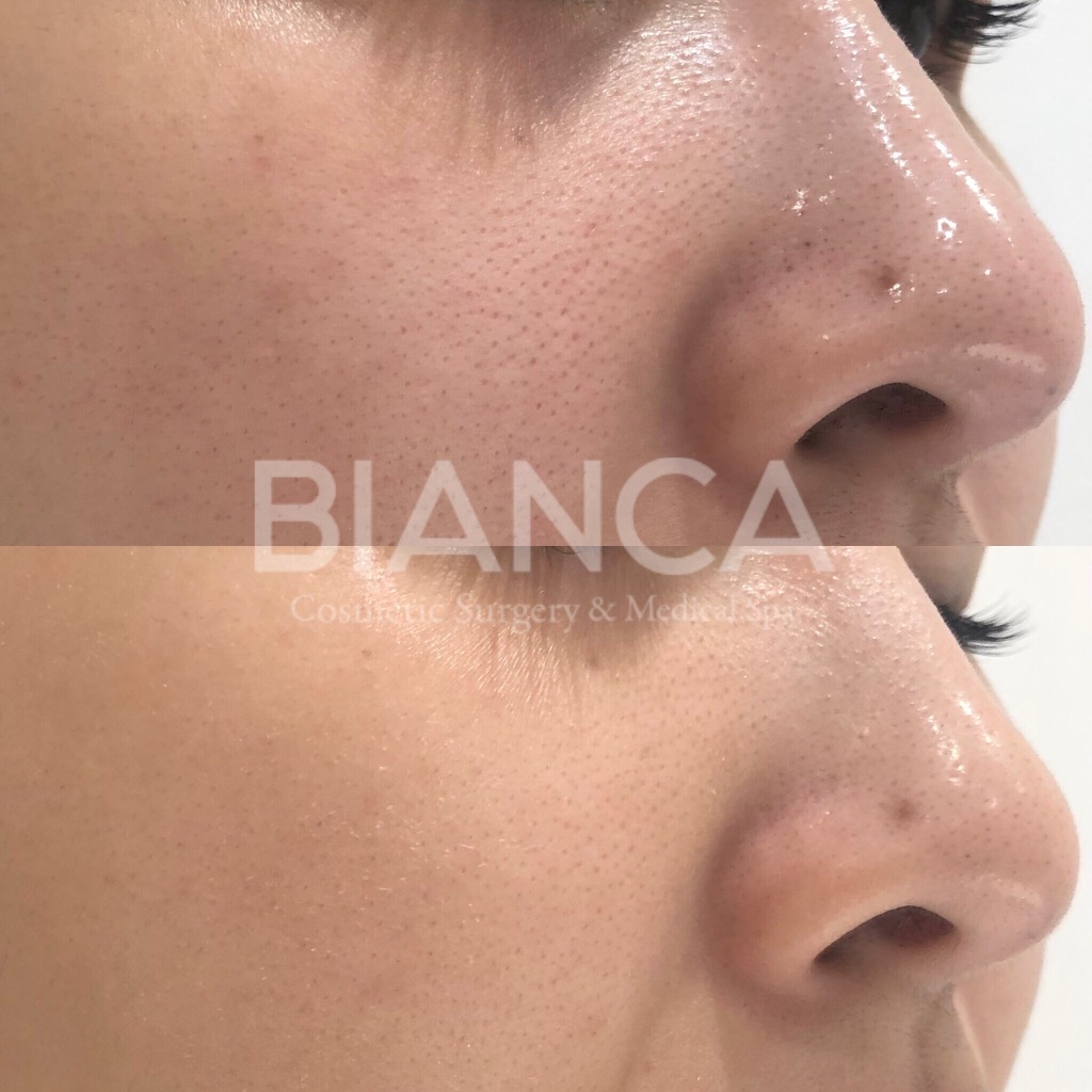 スキンボトックス（ダーマペン4）